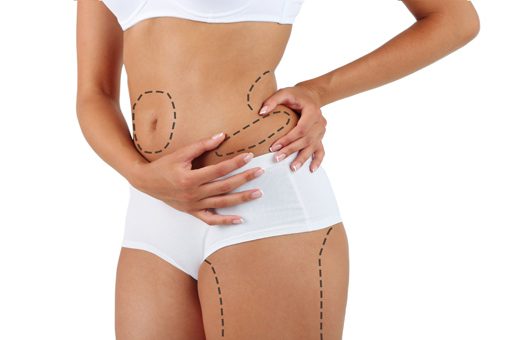 Liposuction Liposuction