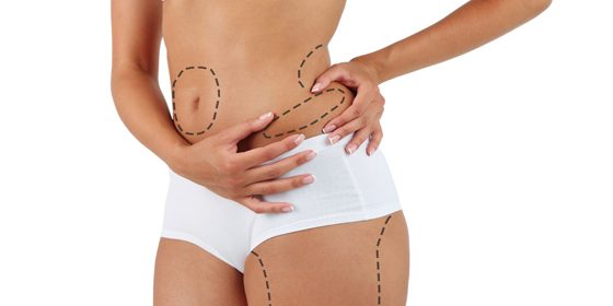 Liposuction