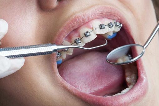 Straighten Your Teeth