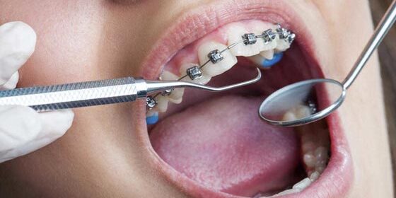 Straighten Your Teeth Straighten Your Teeth